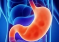 Gastroform questionario tumore