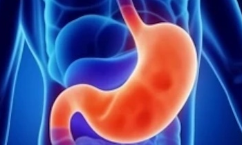 Gastroform questionario tumore
