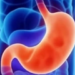 Gastroform questionario tumore